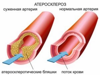Атеросклероз — заболевание артерий, возникающее вследствие нарушения липидного и белкового обмена и сопровождающееся отложением холестерина и некоторых фракций липопротеидов в просвете сосудов Атеросклероз — заболевание артерий, возникающее вследствие нарушения липидного и белкового обмена и сопровождающееся отложением холестерина и некоторых фракций липопротеидов в просвете сосудов
