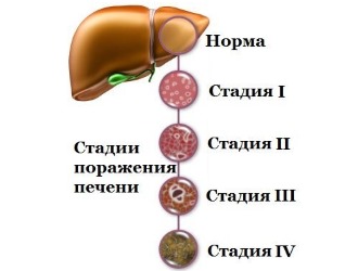 Стадии поражения печени Стадии поражения печени