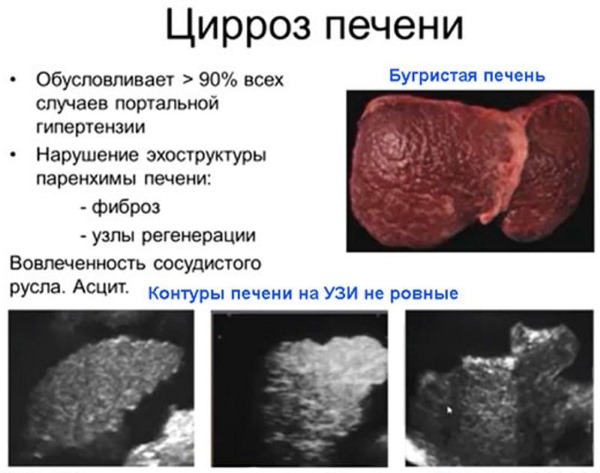 Цирроз печени на УЗИ Цирроз печени на УЗИ