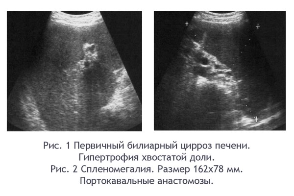Первичный цирроз на УЗИ (Рис. 1) Первичный цирроз на УЗИ (Рис. 1)