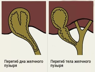 Перегибы дна и тела желчных пузырей Перегибы дна и тела желчных пузырей