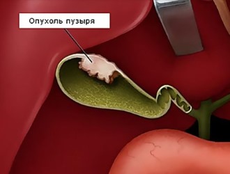 Опухоль может иметь как злокачественную, так и доброкачественную природу Опухоль может иметь как злокачественную, так и доброкачественную природу