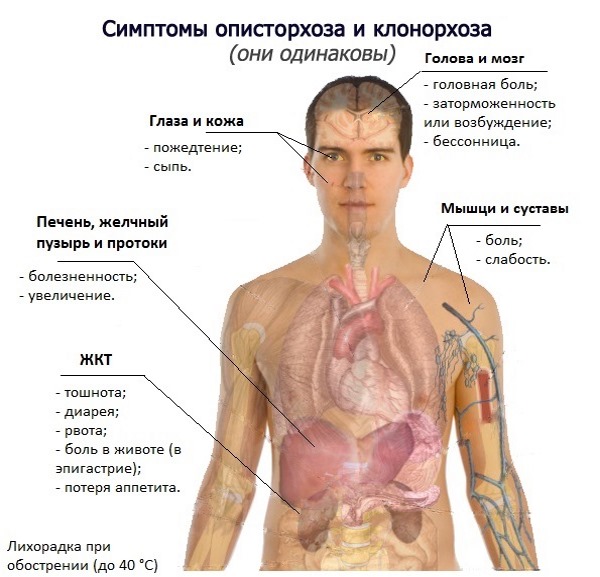 Симптомы описторхоза Симптомы описторхоза