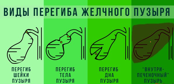 Виды перегибов Виды перегибов