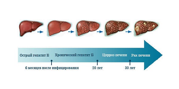 Часто опухоли развиваются на фоне других болезней печени