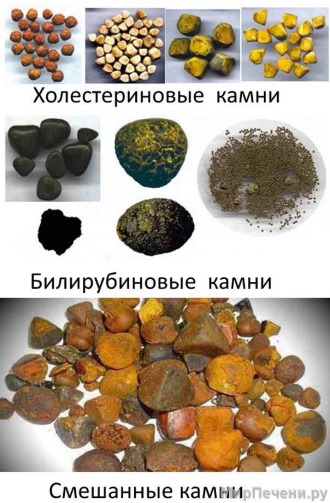 Виды желчных камней Виды желчных камней