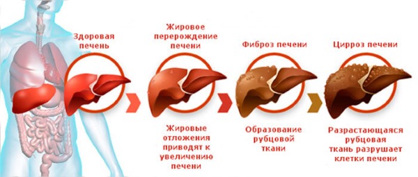 Стадии заболевания печени Стадии заболевания печени