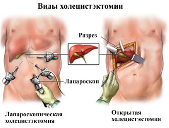 Виды холецистэкомии Виды холецистэкомии