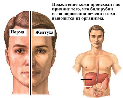 На рисунке отображена разница между нормальным состоянием кожи и при желтухе