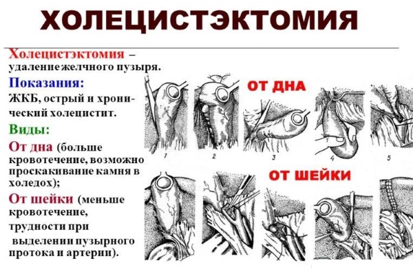 Виды холецистэктомии Виды холецистэктомии