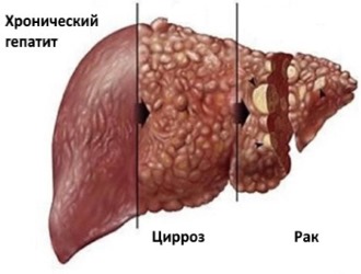 Последствием цирроза может стать рак печени Последствием цирроза может стать рак печени