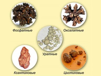 Уратные и оксалатные камни легче вылечить при ограничении потребления животных белков