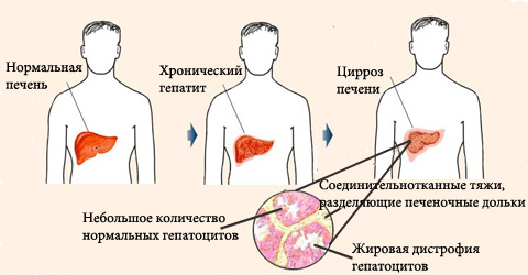 Лекарство оказывает положительное воздействие на печень и помогает предотвратить паталогии, изображенные на картинке