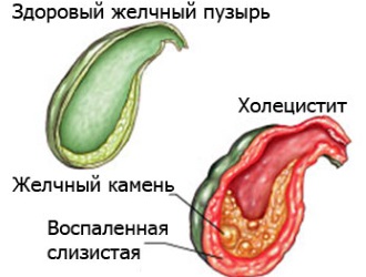 Отличия здорового и пораженного желчного пузыря