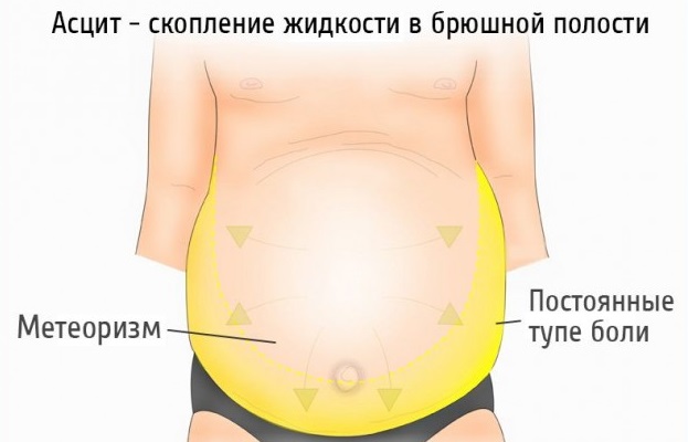При асците наблюдается боль в животе и метеоризм