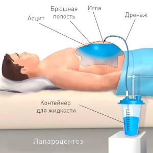 Таким образом выглядит лапароцентез