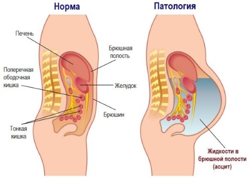 Норма и патология (асцит) Норма и патология (асцит)