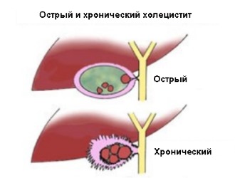 Наглядный пример острого и хронического холецистита Наглядный пример острого и хронического холецистита