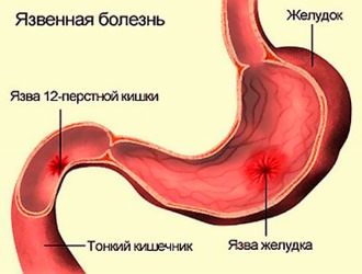 Нельзя принимать настойку полыни при язвах Нельзя принимать настойку полыни при язвах
