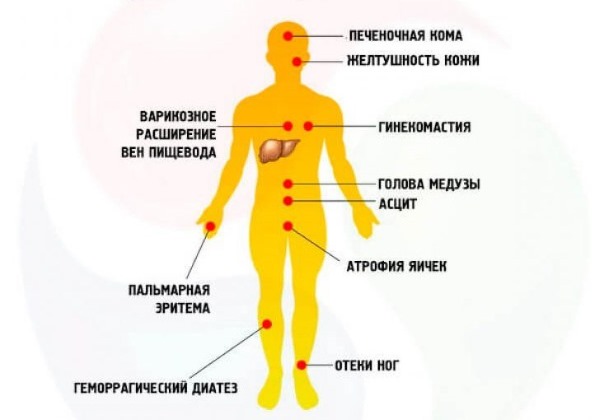 Цирроз печени вызывает тяжелые осложнения Цирроз печени вызывает тяжелые осложнения