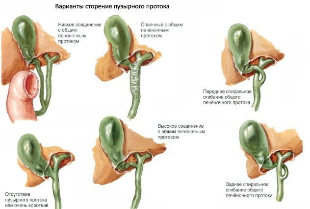 Возможные разные варианты деформации желчного пузыря