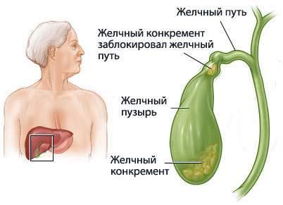 Если не устранить причину застоя, то состояние желчного пузыря будет постоянно ухудшаться