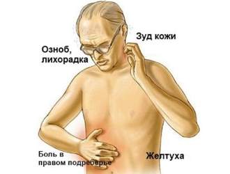 При застое желчи могут возникать такие симптомы