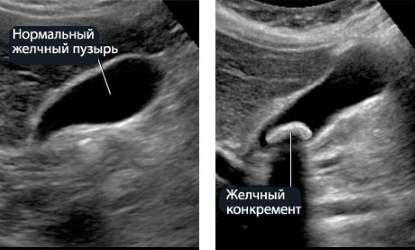 При диагностике могут быть выявлены и другие недуги, к примеру, камни в желчном пузыре