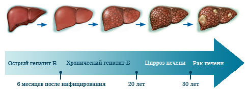 Следующим образом гепатит может перерасти в рак печени