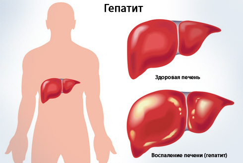 Препарат помогает справиться с вирусными гепатитами. Пораженная печень выглядит так