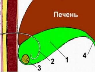 Схема проведения сеанса растворения желчного камня в виде контактного химического литолиза, где: 1. Желчный пузырь; 2. Трубочка-катетер, введенная в желчный пузырь; 3. Камень; 4. Пузырный проток. Схема проведения сеанса растворения желчного камня в виде контактного химического литолиза, где: 1. Желчный пузырь; 2. Трубочка-катетер, введенная в желчный пузырь; 3. Камень; 4. Пузырный проток.