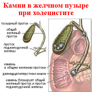 Камни в желчном пузыре