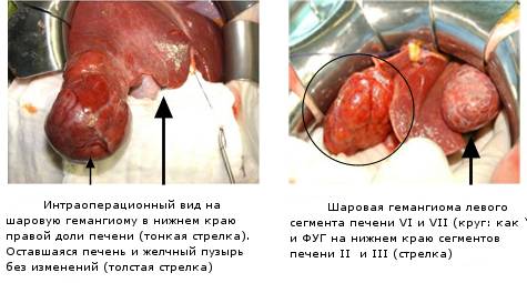 gemangiomapecheni_prim.png