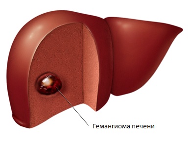 Так схематично выглядит недуг