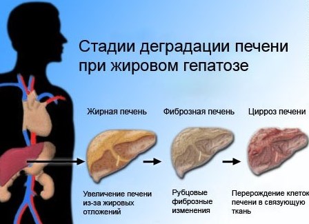 Стадии гепатоза