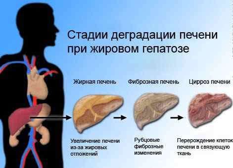 Стадии жирового гепатоза