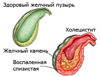 Наглядная разница между здоровым и больным органом Наглядная разница между здоровым и больным органом