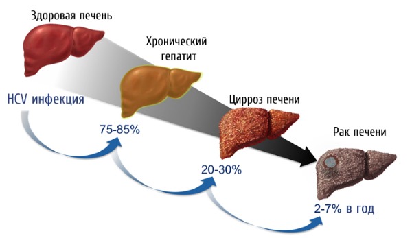 Течение недуга с осложнениями Течение недуга с осложнениями