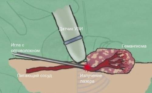 Иногда используют закупоривание сосуда, питающего гемангиому