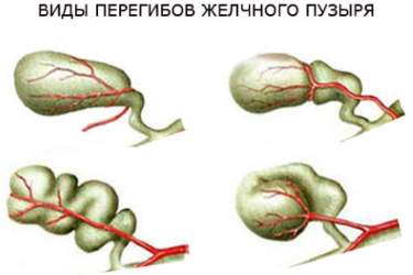 Виды перегибов желчного пузыря