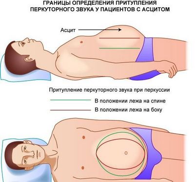 Границы определения притупления перкуторного звука у пациентов с асцитом Границы определения притупления перкуторного звука у пациентов с асцитом