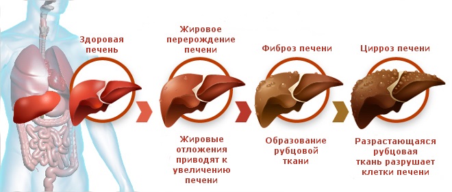 Прием Силимара рекомендуется для предотвращения развития цирроза печени