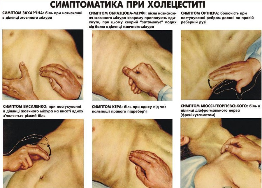 На картинке отображены симптомы холецистита