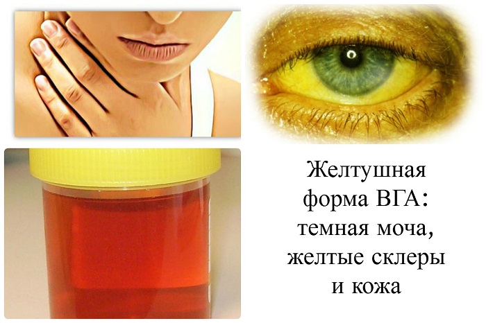 Основные симптомы гепатита А