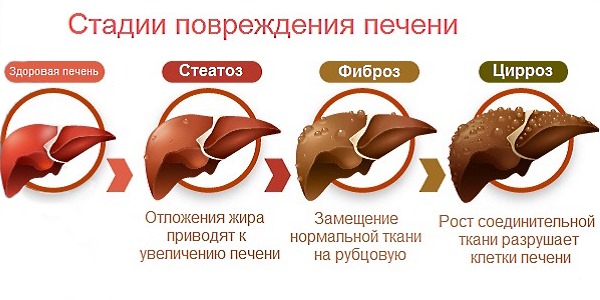 Стадии повреждения печени Стадии повреждения печени