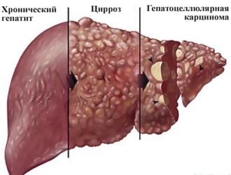 Острая форма заболевания в большинстве случаев переходит в хроническую, которая наиболее опасна для человека Острая форма заболевания в большинстве случаев переходит в хроническую, которая наиболее опасна для человека