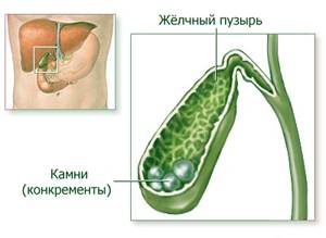 Одно из показаний к применению - выведение камней их желчного пузыря