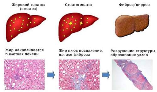 Патология может привести к серьезным проблемам с печенью