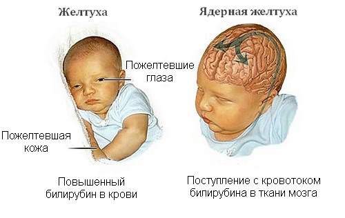 Симптоматика желтухи