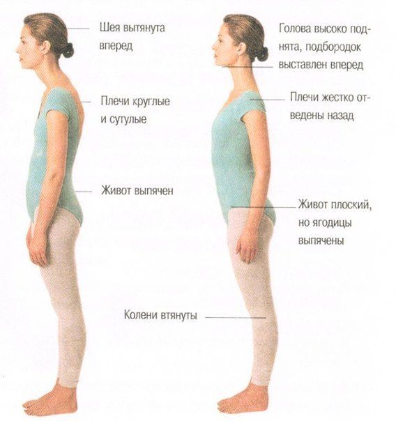 Нарушение осанки: патология и норма